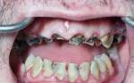 Meth Mouth