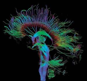 Schultz Thalamus Diffusion Tensor